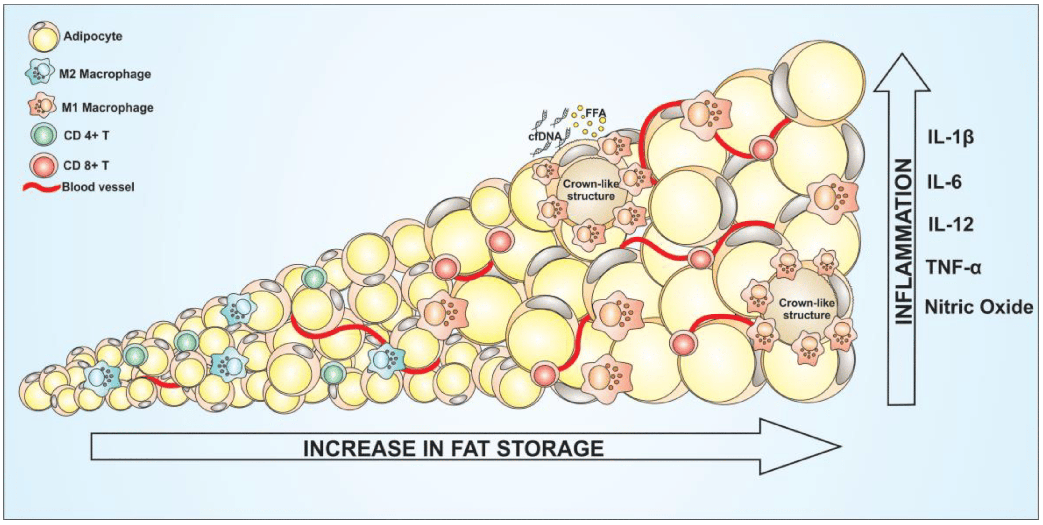 Adipose tissue inflammation in obesity: when an adipocyte hypertrophies beyond its capacity, it undergoes stress and death. Macrophages are recruited and form a crown-like structure around the dead cell, secreting TNF-alpha and IL-6. This diagram shows the lipid-overflow-to-inflammation sequence that links adipocyte hypertrophy to systemic insulin resistance.