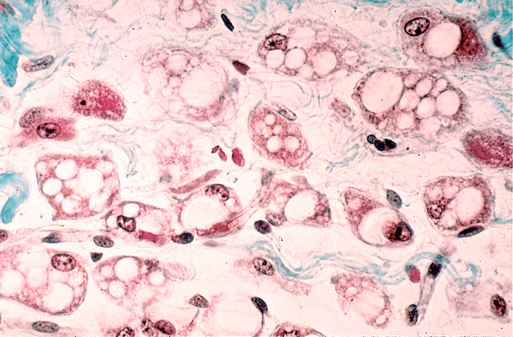 Brown adipose tissue, histological section. Multilocular adipocytes with smaller lipid droplets and cytoplasm-rich cells, distinct from the unilocular white adipocyte. The denser, more granular cytoplasm reflects the high mitochondrial content that drives UCP1-mediated thermogenesis.